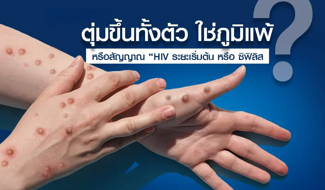 ตุ่มขึ้นทั้งตัว ใช่ภูมิแพ้? หรือสัญญาณ “HIV ระยะเริ่มต้น หรือ ซิฟิลิส