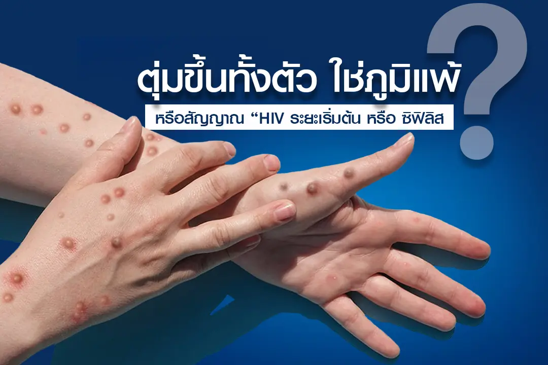 ตุ่มขึ้นทั้งตัว ใช่ภูมิแพ้? หรือสัญญาณ “HIV ระยะเริ่มต้น หรือ ซิฟิลิส
